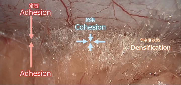 Adhesion、Cohesion、Densificationの関係：写真は熊谷総合病院 泌尿器科 川島清隆先生の撮像